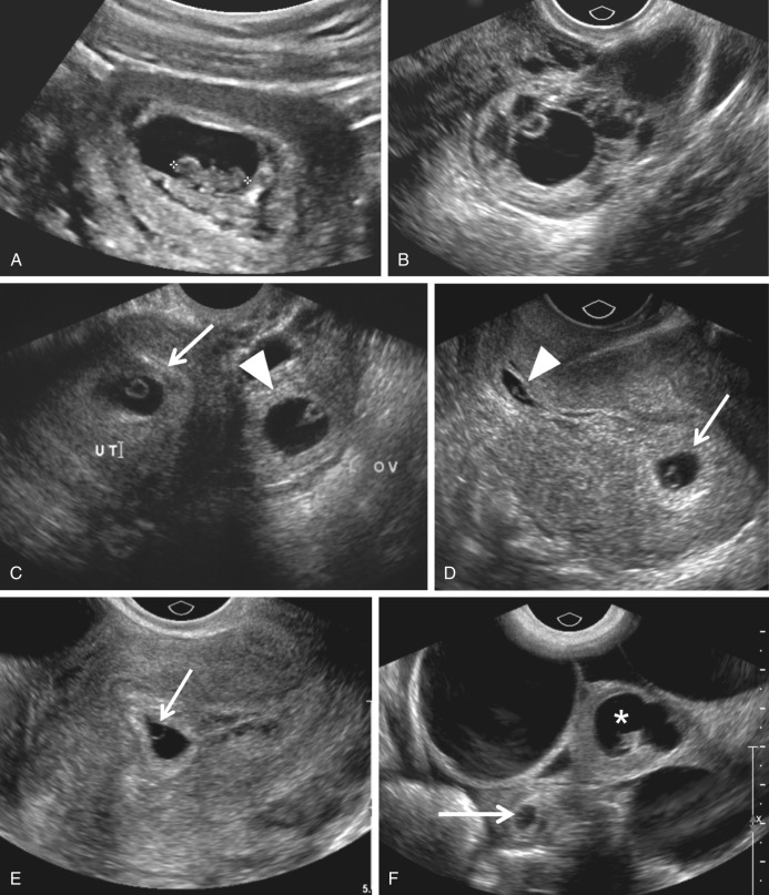 9 Week Ectopic Pregnancy Ultrasound