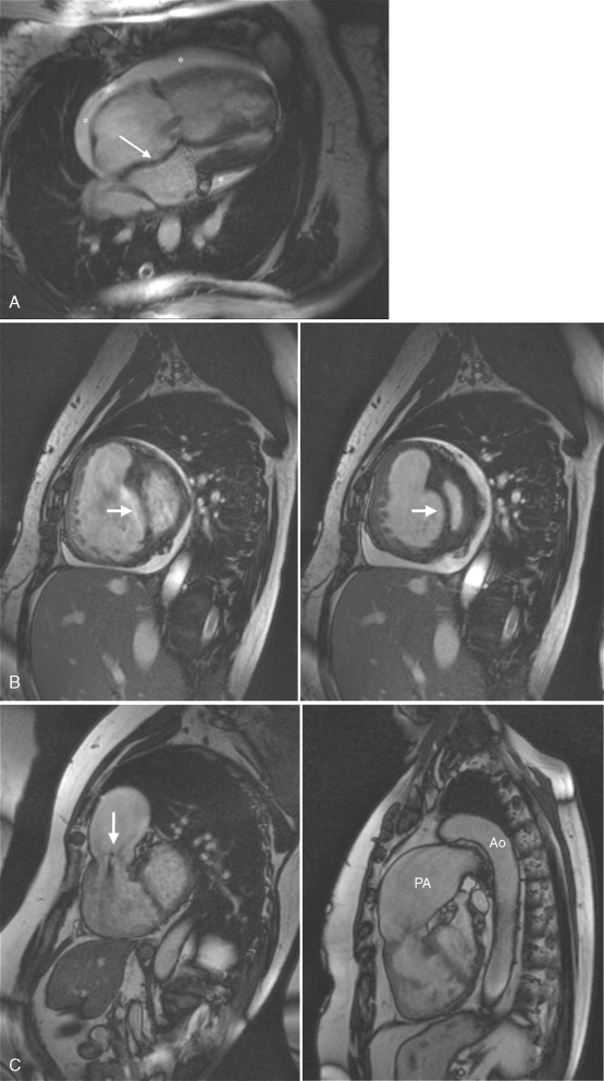 Size and Function of the Right Ventricle | Radiology Key
