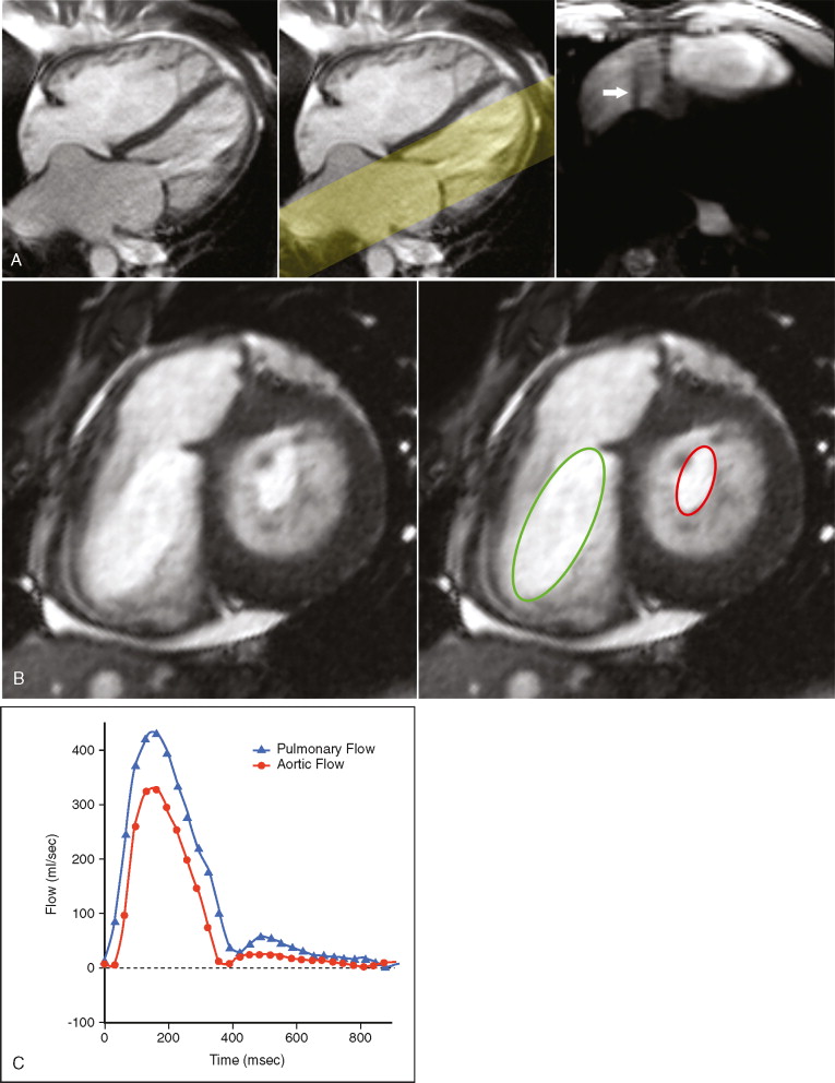 Valvular Heart Disease | Radiology Key