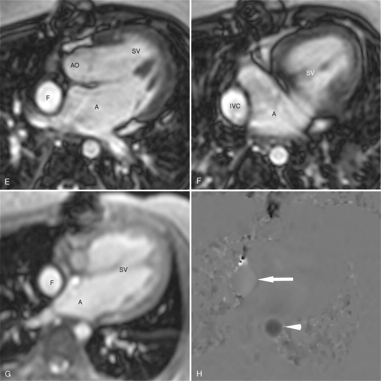 Postoperative Evaluation Of Congenital Heart Disease Radiology Key