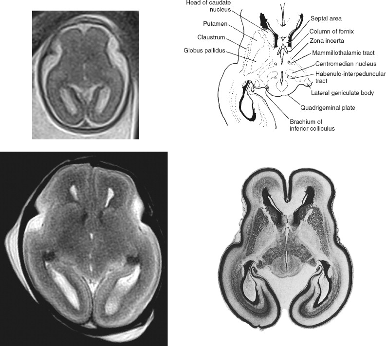 Sectional Anatomy of the Fetal Brain | Radiology Key
