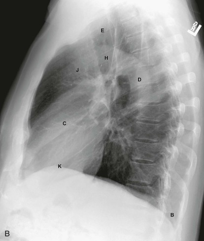 The Normal Chest X-Ray: Reading Like the Pros | Radiology Key