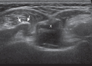 Shoulder Ultrasound | Radiology Key