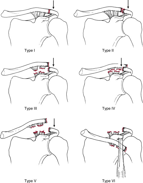 The Shoulder | Radiology Key