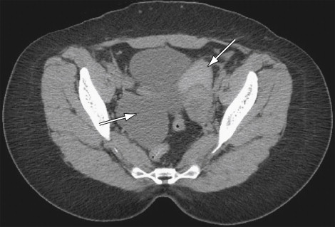 Uterus Endometriosis Ct Scan Tumors Of The Uterine Corpus Clinical
