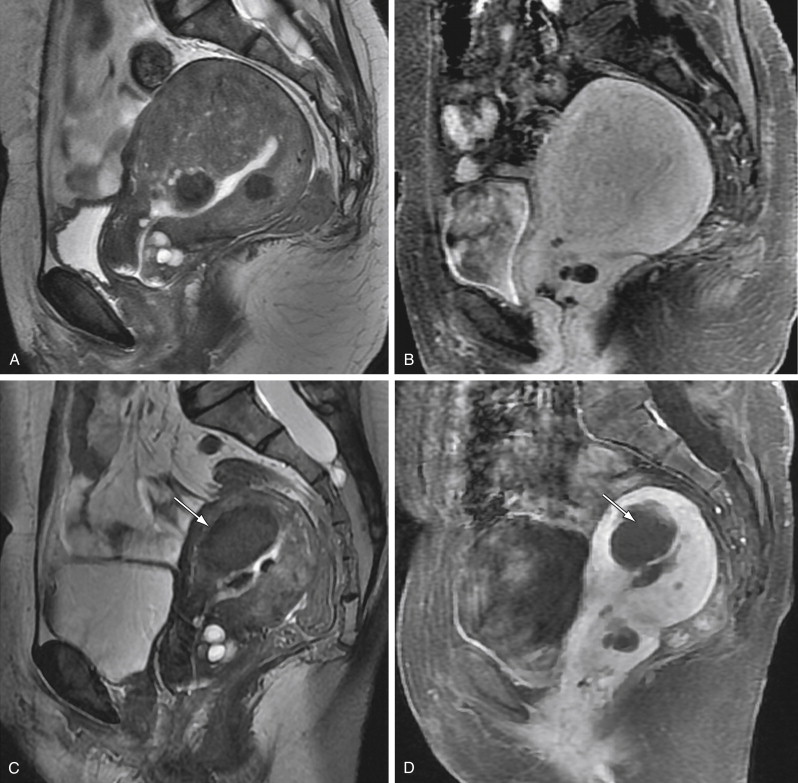 Adenomyosis Uterus Mri 3134