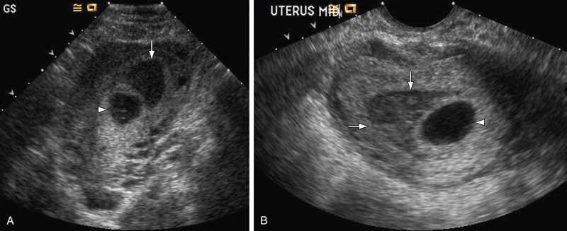 Normal and Abnormal US Findings in Early First-Trimester Pregnancy: Review  of the Society of Radiologists in Ultrasound 2012 Consensus Panel  Recommendations | RadioGraphics