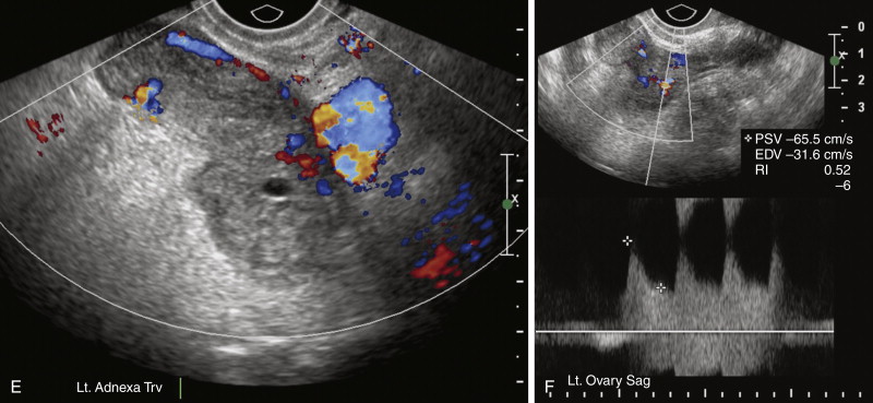 Roentgen Ray Reader: Tubal Ectopic Pregnancy