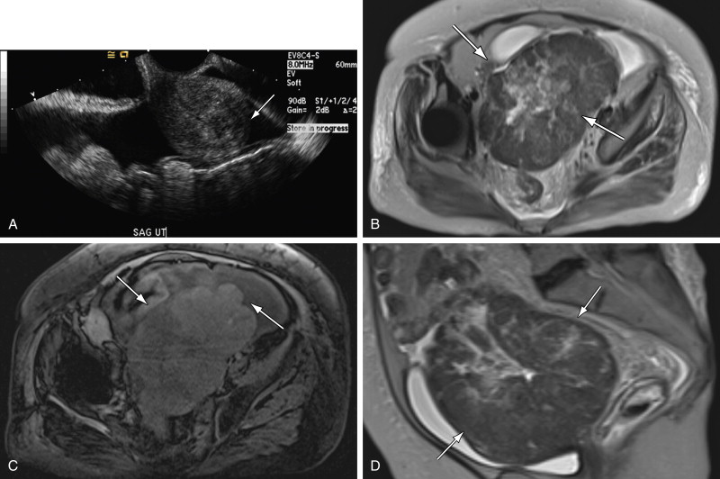 Uterine Cancer Ultrasound