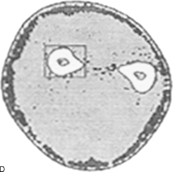 Imaging Evaluation Of Osteoporosis | Radiology Key