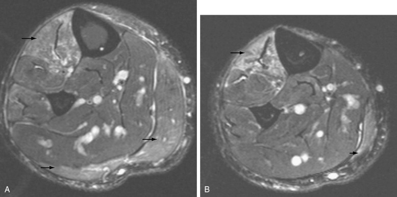 Imaging of Diabetes Mellitus and Neuropathic Arthropathy: The Diabetic ...