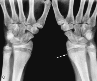 Oncogenic Osteomalacia | Radiology Key