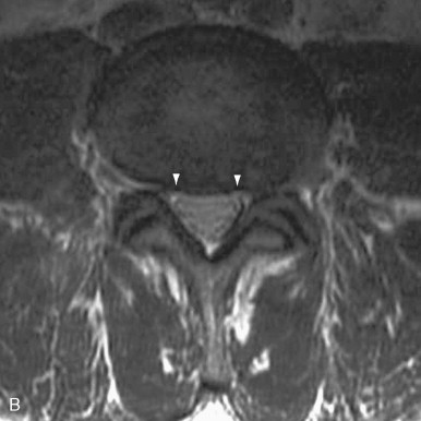 Degenerative Disorders of the Spine | Radiology Key