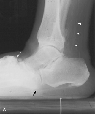 Imaging of Diabetes Mellitus and Neuropathic Arthropathy: The Diabetic ...