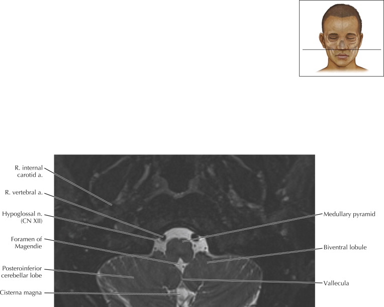 Brainstem And Cranial Nerves Radiology Key 7375