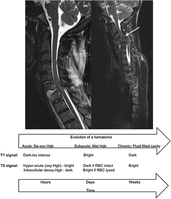 Traumatic Spinal Cord Injury Acute Spinal Cord Injury And Prognosis 