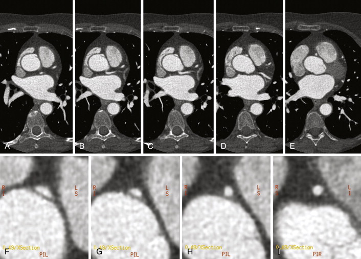 Coronary Artery Anomaliesof Origin and Course Radiology Key