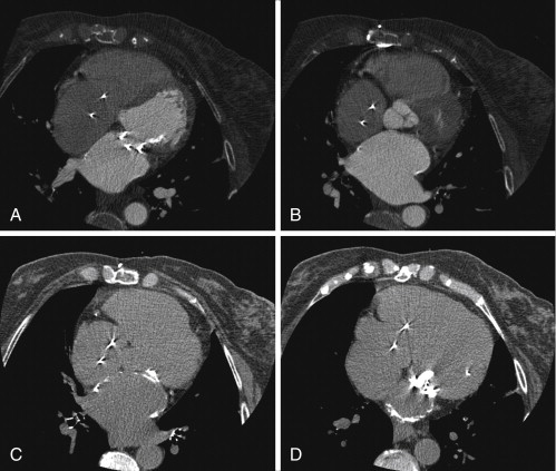 Assessment of Left Ventricular Structural Abnormalities | Radiology Key