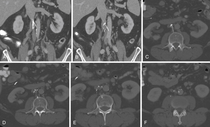 Caval Anatomy: Variants and Lesions | Radiology Key