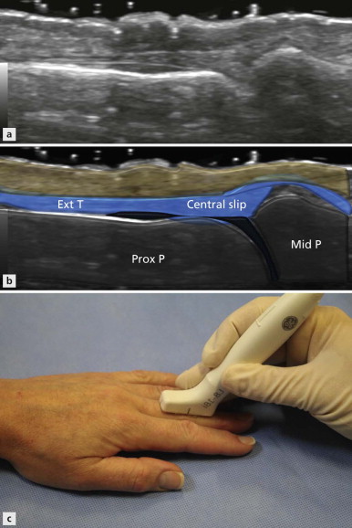 Finger Anatomy and Techniques | Radiology Key