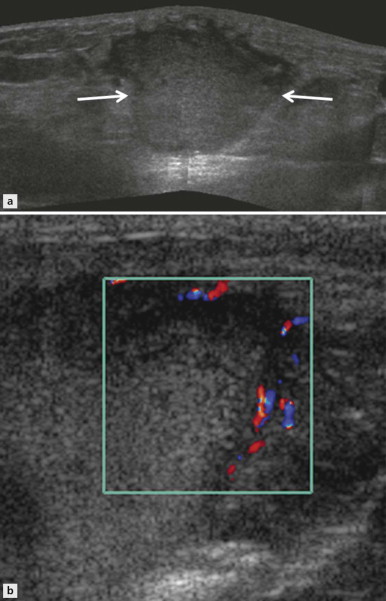 Ultrasound Of Soft Tissue Masses Radiology Key