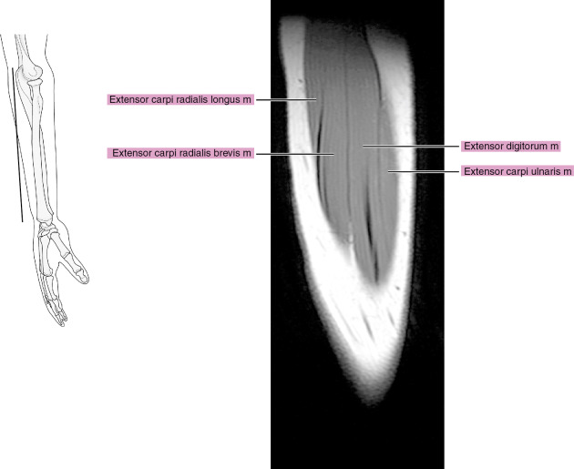 MRI of the forearm | Radiology Key