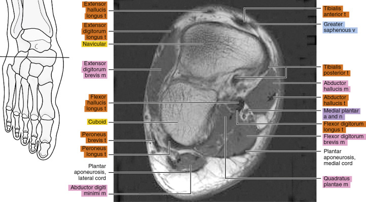 MRI of the thigh | Radiology Key