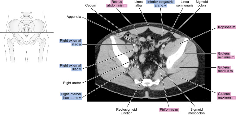 CT of the male pelvis | Radiology Key
