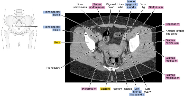 CT of the female pelvis | Radiology Key