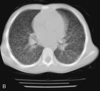 Pulmonary Manifestations Of Human Immunodeficiency Virus (hiv 