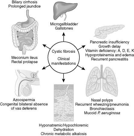 Pulmonary Manifestations of Genetic Diseases | Radiology Key