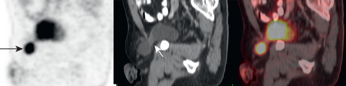 Heart on FDG PET/CT | Radiology Key