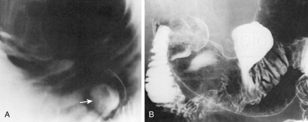 Difference Between Single And Double Contrast Study