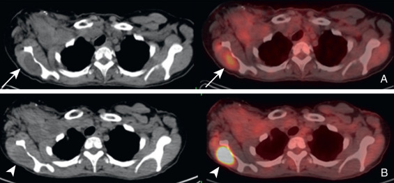 Muscle and Nerve on FDG PET/CT | Radiology Key