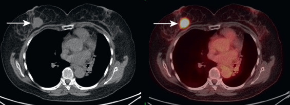 Skin and Breast on FDG PET/CT | Radiology Key