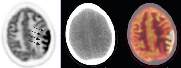 brain-on-fdg-pet-ct-radiology-key