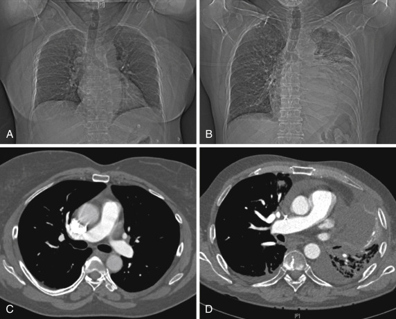 Strategies for Reducing Radiation Exposure From Multidetector Computed ...