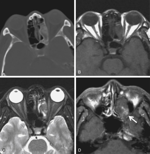 Anterior Skull Base Radiology Key 6056