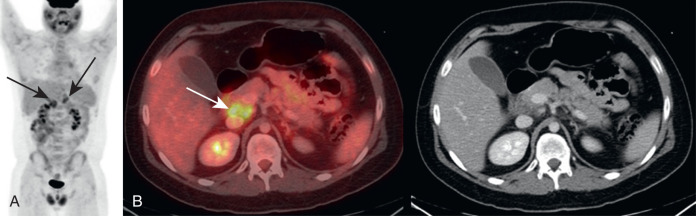 Pancreas on FDG PET/CT | Radiology Key