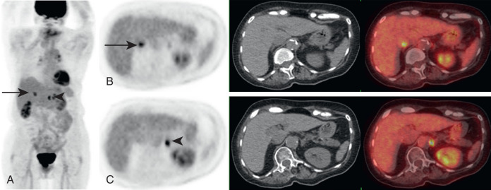 Adrenal Glands on FDG PET/CT | Radiology Key