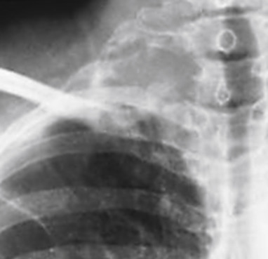 Chest Wall Lesions | Radiology Key