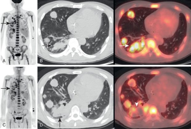 Can Sarcoidosis Affect The Kidneys