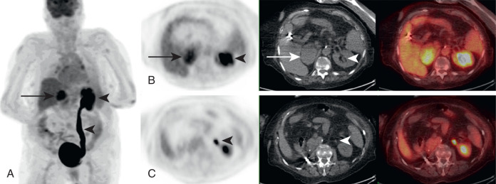 Artifacts On FDG PET/CT | Radiology Key