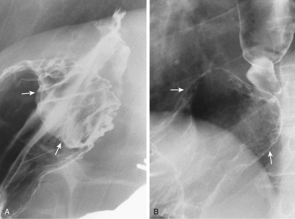 Abnormalities of the Gastroesophageal Junction | Radiology Key