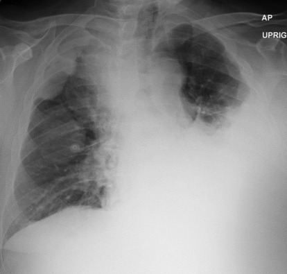 Anterior Pleural Effusion