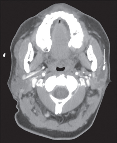 Sjögren Syndrome | Radiology Key