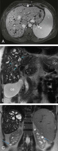 Anomalies and Anatomic Variants of the Gallbladder and Biliary Tract ...