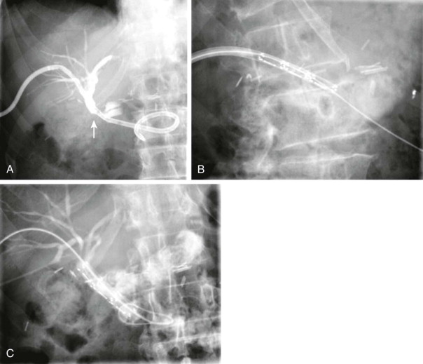 Interventional Radiology Of The Gallbladder And Biliary Tract ...