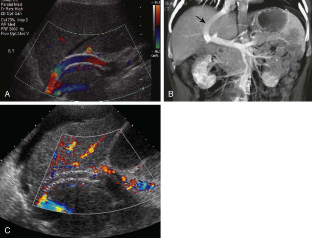 diffuse-liver-disease-radiology-key