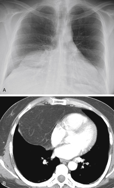 anterior-mediastinal-mass-radiology-key